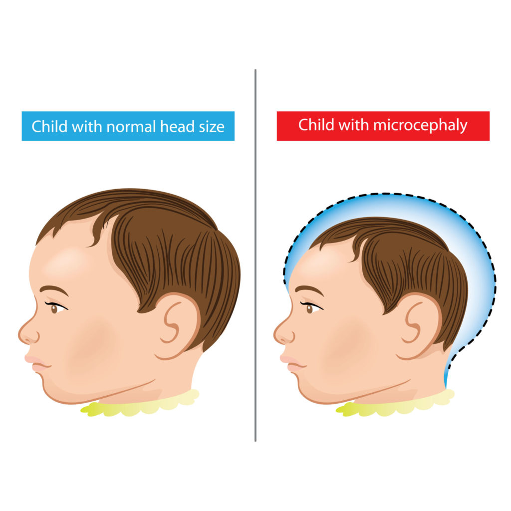 Diferença entre criança com tamanho de cabeça normal e criança com microcefalia