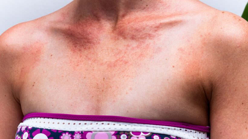 Por que o câncer da pele é tão comum no Brasil e como você pode se prevenir?