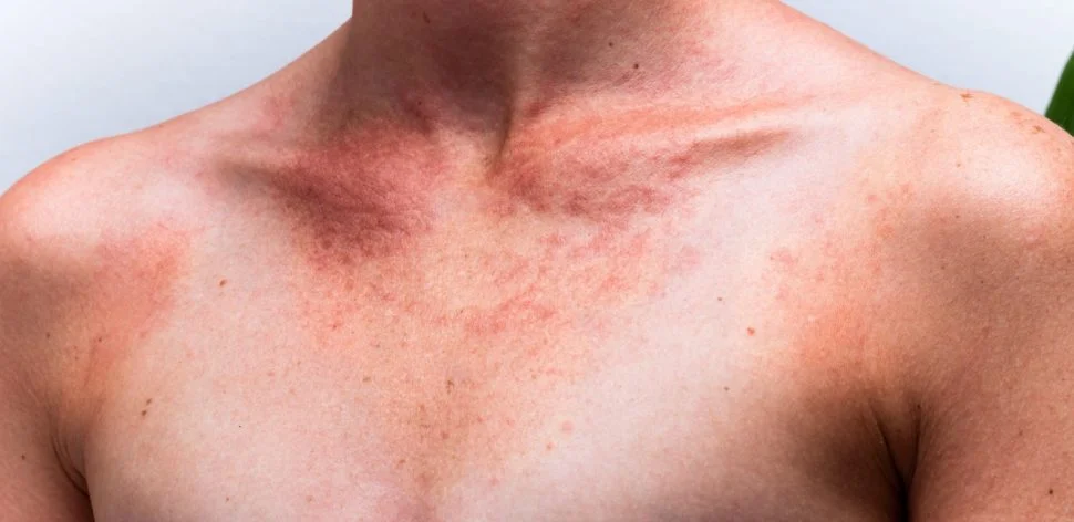 Por que o câncer da pele é tão comum no Brasil e como você pode se prevenir?