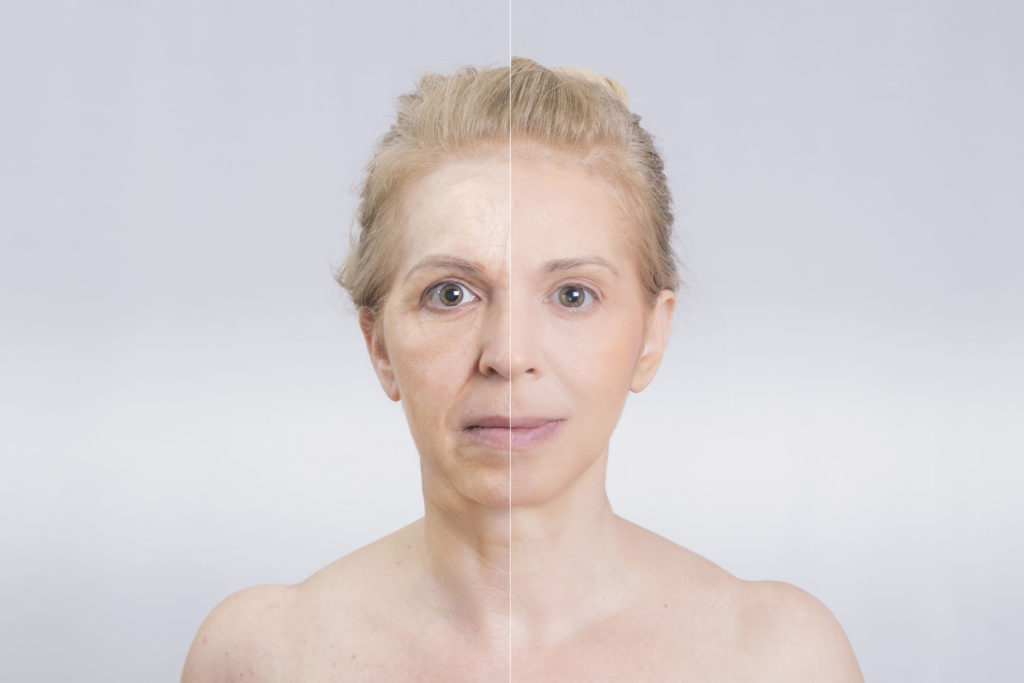 Mulher antes e depois de cirurgia plástica