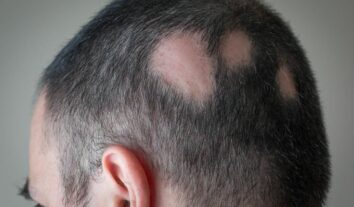 Novo remédio contra queda de cabelo é aprovado pela Anvisa