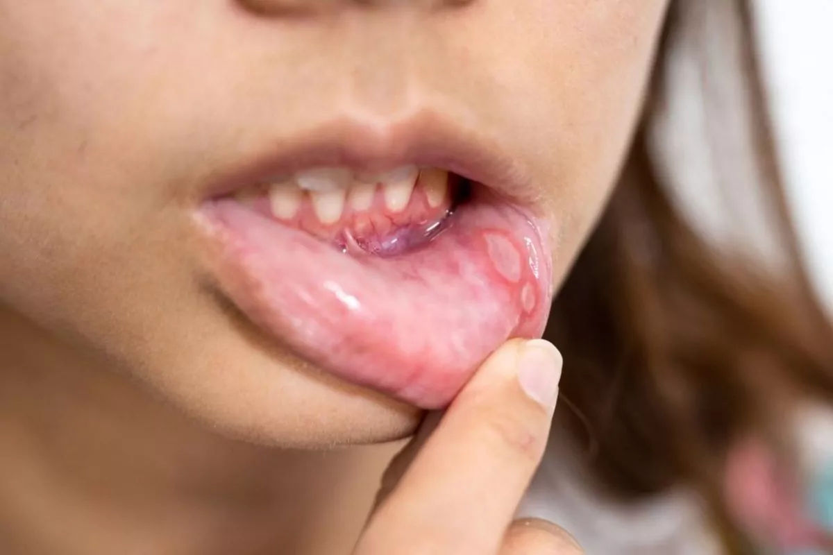 Tratamentos simples ajudam a aliviar a dor causada pelas aftas na boca | Imagem: Twitter/X